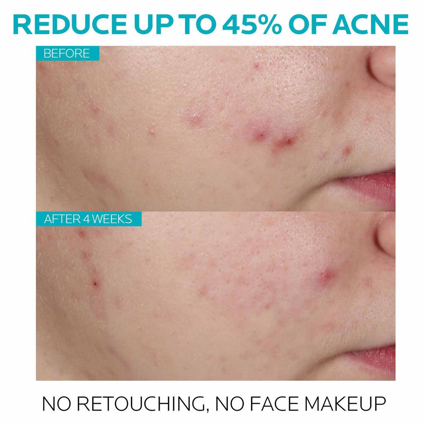 effaclar-salicylic-acid-acne-treatment-serum-a3 7_EffaclarSerum_After-45-days.jpg