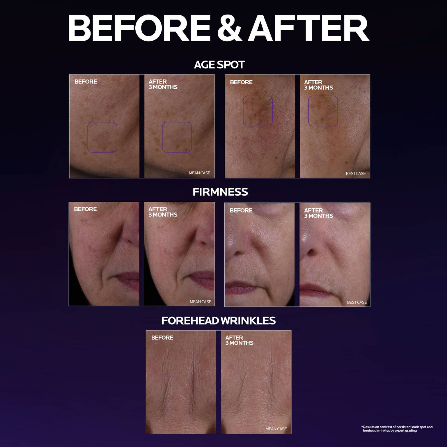 mela-b3-double-dose-discoloration-treatment-with-melasyltm-k4 MelaB3_DD_BTF_BeforeAfter_1500x1500_5.jpg
